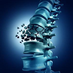 Three-dimensional view of a vertebral compression fracture collapsing the front of a vertebra.