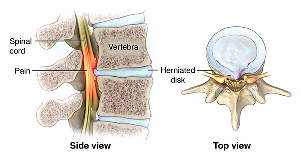 Side view and top view of a herniated disc pressing on the spinal cord between two vertebrae.