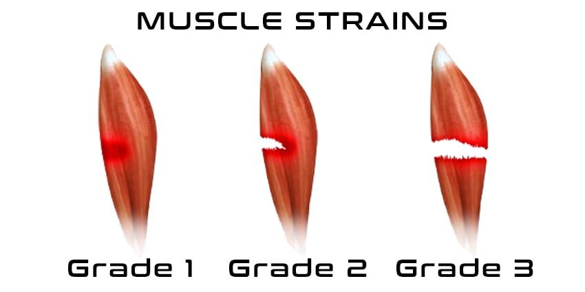 Three muscle bellies showing strain grades 1, 2 and 3, with increasing tearing of the fibres.