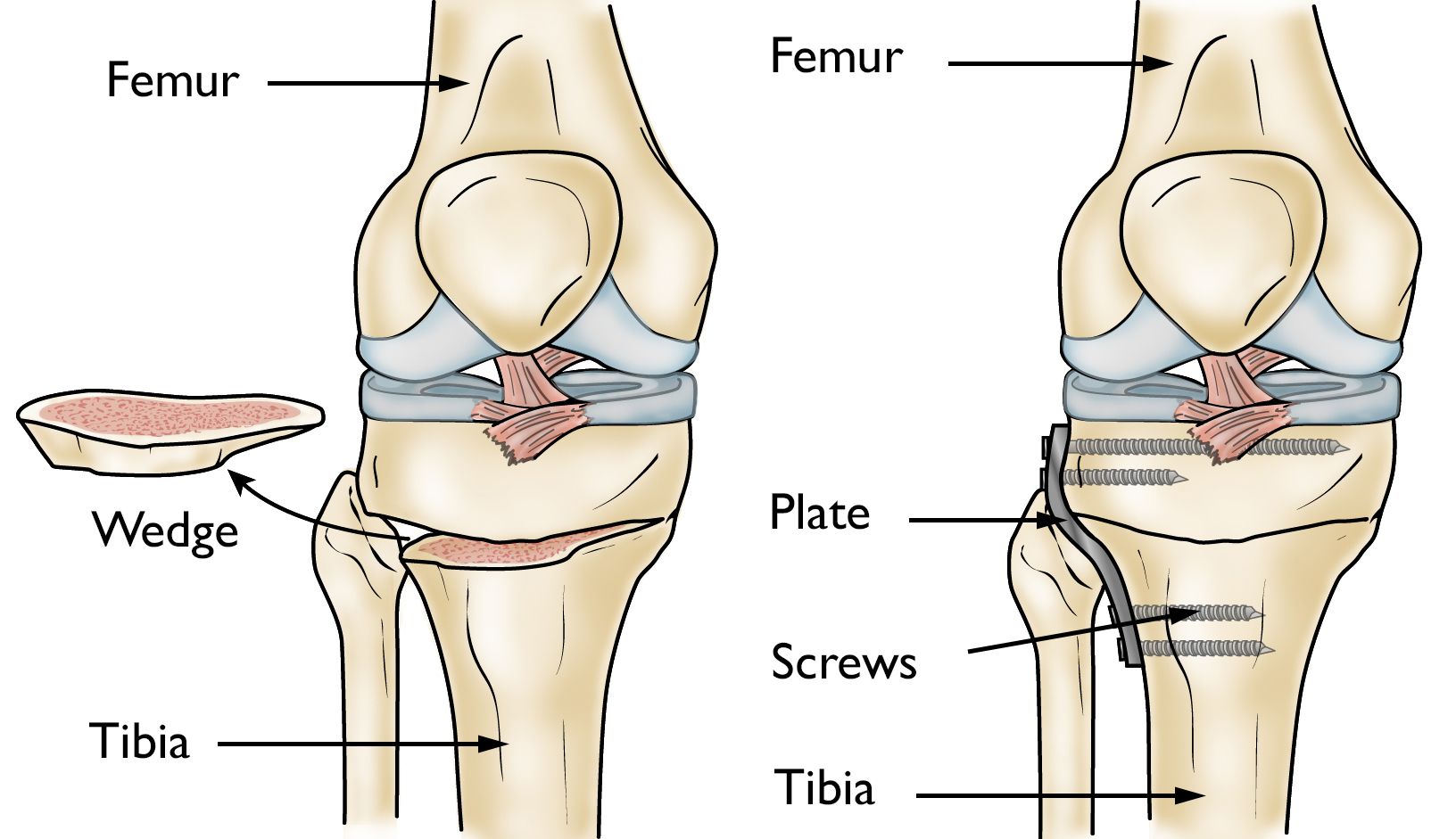 Two illustrations of a tibial osteotomy: a wedge of bone removed to straighten a bowed leg, and the corrected bone after fixation.